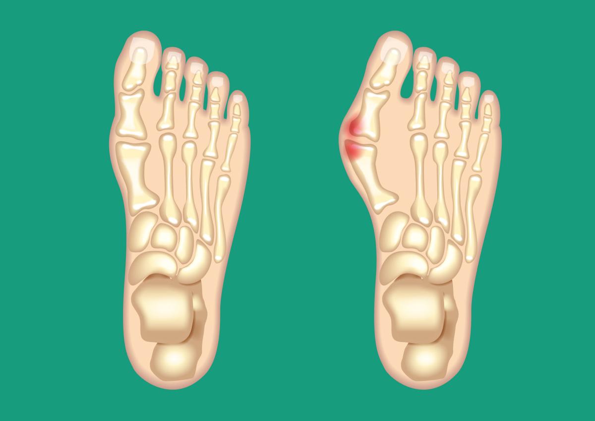 Bunion Removal