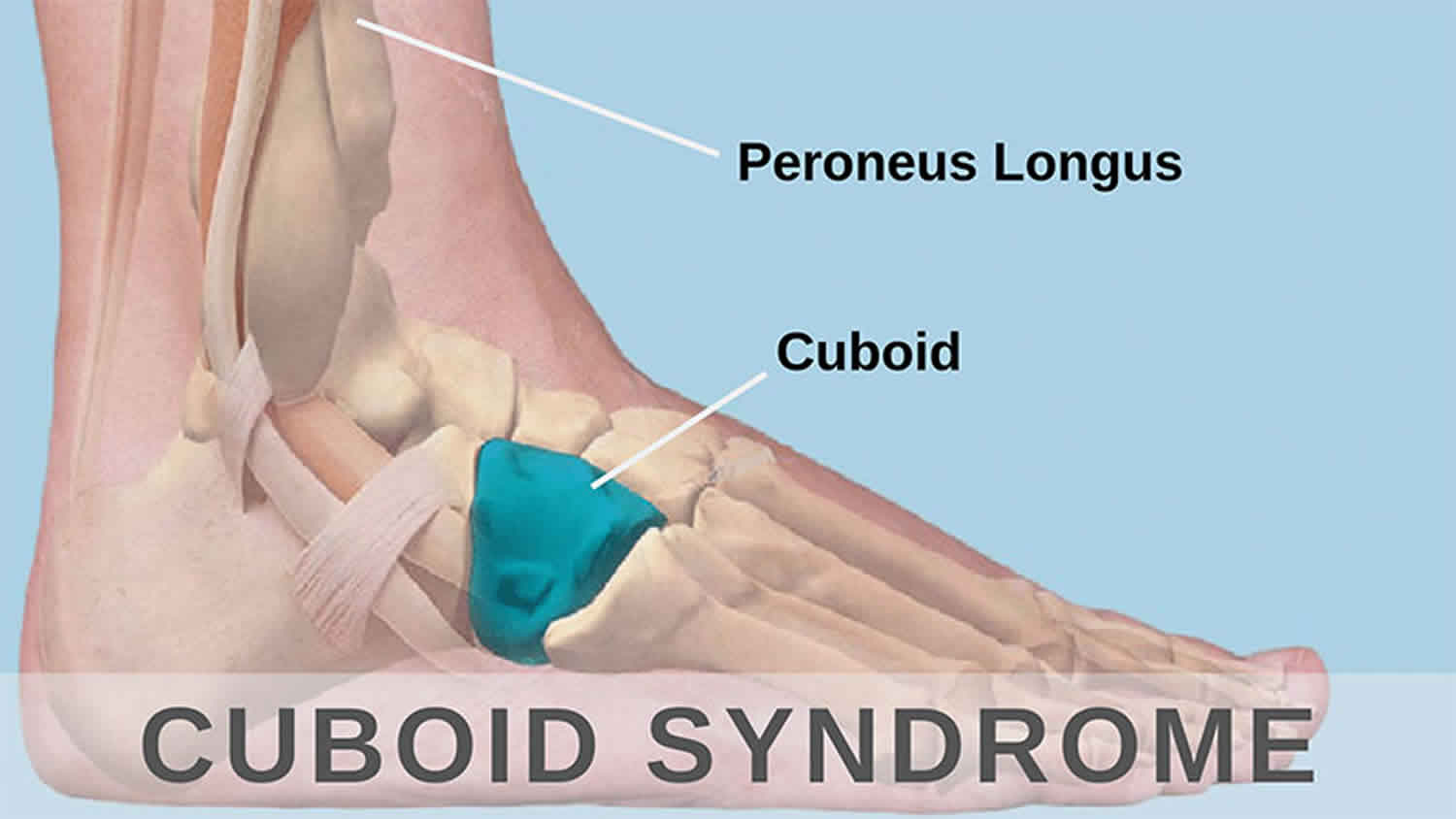 Cuboid Syndrome